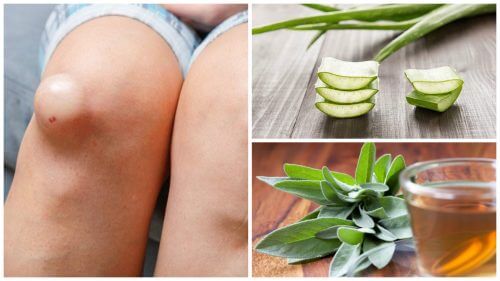 تورم الركبة - أفضل 5 علاجات طبيعية تساعدك على تخفيف تورم الركبة