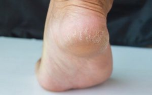 جفاف وتشقق الكعبين - 6 وسائل تستطيع من خلالها مكافحة هذه الأعراض