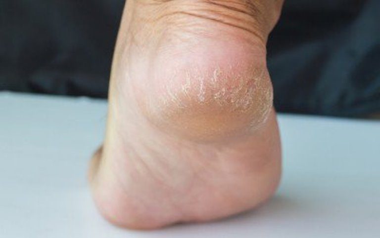 جفاف وتشقق الكعبين - 6 وسائل تستطيع من خلالها مكافحة هذه الأعراض