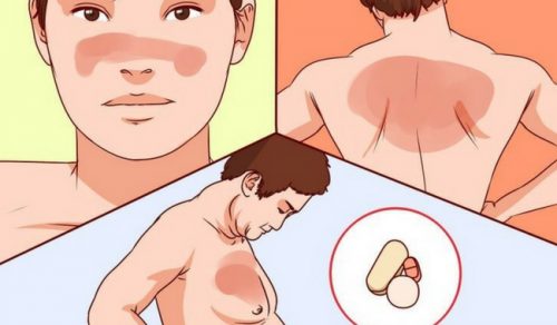 داء الذئبة المناعي الذاتي - معلومات تحتاج إلى معرفتها عن الحالة