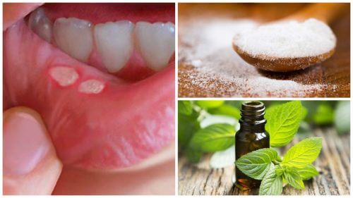 التقرحات الفموية - 7 علاجات طبيعية لمكافحة تقرحات الفم