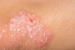 التهاب الجلد التأتبي - أفضل علاجات طبيعية متاحة للإكزيما