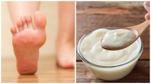 مسامير القدم – تخلص منها عن طريق علاج الخل والزبادي الطبيعي