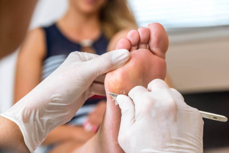 مشكلة الجسأة الجلدية - أفضل العلاجات البديلة للتخلص من مسامير القدم