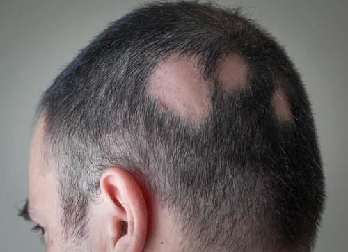 مكافحة الثعلبة - حلول طبيعية تساعدك على مكافحة فقدان الشعر بفعالية