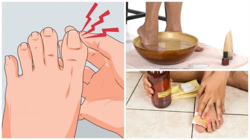 أظافر أصابع القدم الناشبة - 6 علاجات منزلية تساعدك على مكافحة الحالة