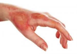 علاج الحروق - علاجات منزلية طبيعية تساعدك على علاج الحروق
