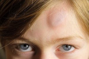 علاج الكدمات - 9 وسائل طبيعية تستطيع من خلالها علاج الكدمات