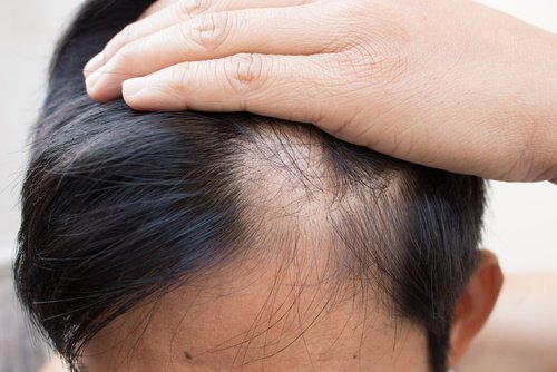 حالة الثعلبة - 6 علاجات طبيعية قد تساعدك على مكافحة المشكلة