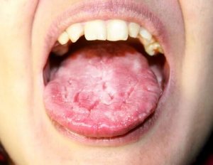داء المبيضات - اكتشف المزيد من المعلومات عن هذه العدوى المزعجة
