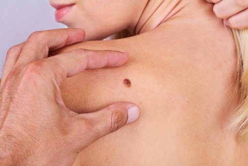 سرطان الجلد – اكتشف 6 أعراض لا يجب عليك تجاهلها أبدًا