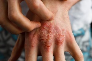 علاج الصدفية - العلاجات والأدوية التي تساعد في علاج هذه الحالة