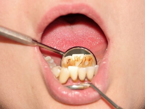 قلح الأسنان - اكتشف كيفية إزالة قلح الأسنان بوسائل طبيعية فعالة