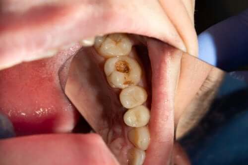 ما أسباب إصابة الأسنان بالتسوس وكيف يمكن تجنب المشكلة؟