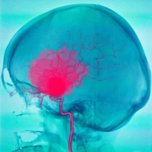 ماذا يجب أن تعرف عن حالة الشلل الدماغي؟