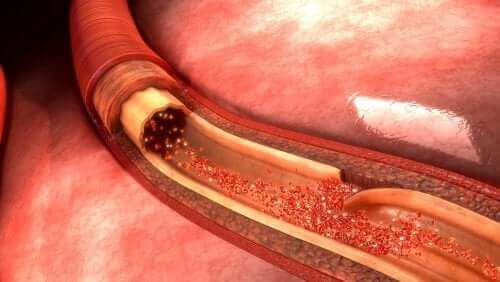 ما تحتاج إلى معرفته عن حالة تمدد الأوعية الدموية الأبهري