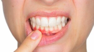 خراجات الأسنان - اكتشف كيفية علاجها معنا اليوم