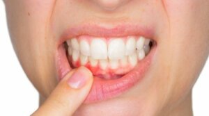 خراجات الأسنان - اكتشف كيفية علاجها معنا اليوم