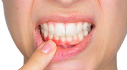 خراجات الأسنان – اكتشف كيفية علاجها معنا اليوم