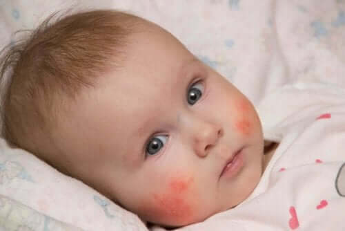 طفل يعاني من التهاب الجلد