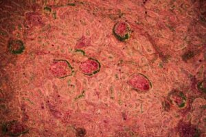 السل الكلوي - اكتشف معنا كيفية تشخيص الحالة علاجها