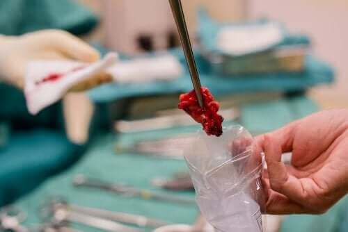 حدود خزعة الأنسجة