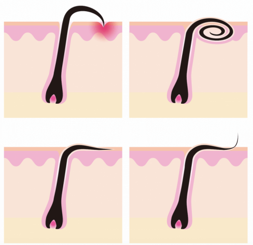 أنواع الشعر الناشب