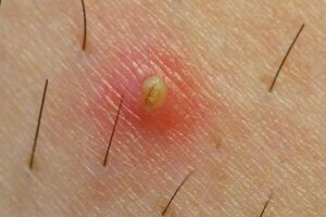 الشعر الناشب - اكتشف لماذا يظهر وكيف تستطيع تجنبه