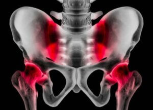 الفتق الرياضي - الأعراض والمسببات، والعلاجات