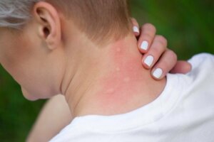 جل فنيستيل - علاج رائع للسعات الحروق وداء الشرى الجلدي