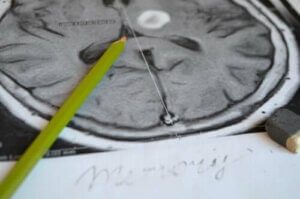 فقد الذاكرة - الأعراض ووسائل الوقاية