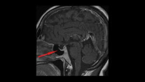 أورام الغدة النخامية - اكتشف معنا أعراضها، كيفية تشخيصها وعلاجها