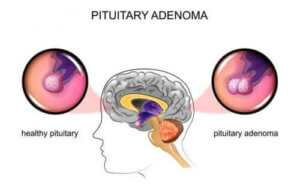 أورام الغدة النخامية: الأسباب والأعراض