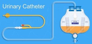 علاج احتباس السوائل التالي للولادة