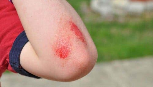 الجروح والخدوش