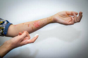 الحروق السطحية - اكتشف معنا كيفية علاجها بفعالية