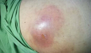 الخراجات البطنية الداخلية - اكتشف معنا مسبباتها، أعراضها وكيفية علاجها