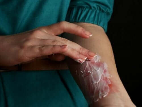 علاج الحروق السطحية