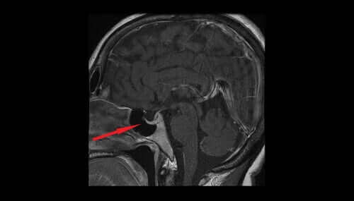 هرمون فازوبرسين