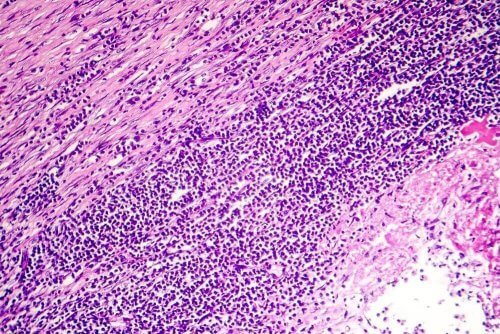 أنواع التهاب التامور