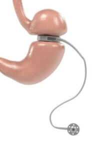 حزام المعدة القابل للتعديل - السمات والاستخدامات