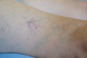 عقار فينوروتون - الصفات والاستخدامات