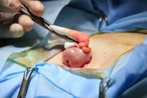 فغر القولون - الغرض، الأنواع والمضاعفات المحتملة