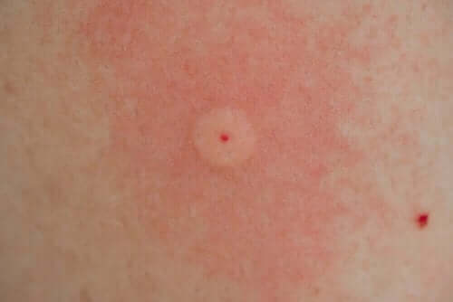 لسعة الدبور الآسيوي