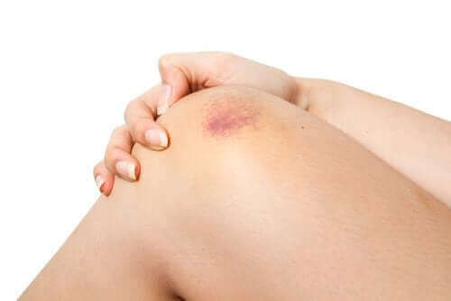 الإصابات السطحية - لماذا وكيف تتشكل الكدمات؟