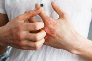 التهاب الجلد التأتبي - كل ما تحتاج إلى معرفته عن الإكزيما التأتبية