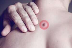 سبب ظهور الكتل الدهنية في منطقة الظهر