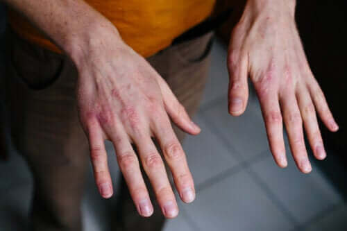 جفاف وتشقق اليدين - المسببات، طرق الوقاية وبعض العلاجات