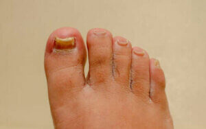 التهاب الأظافر الفطري - كل ما تحتاج إلى معرفته عن الحالة