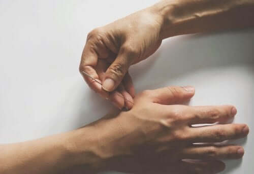 الوخز بالإبر